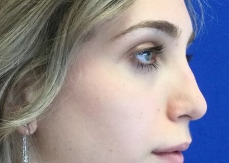 Preservation rhinoplasty for a